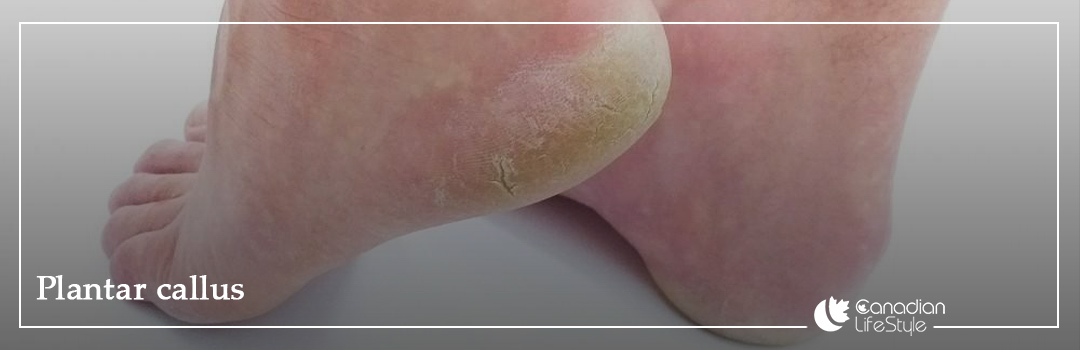 Treatment plantar callus