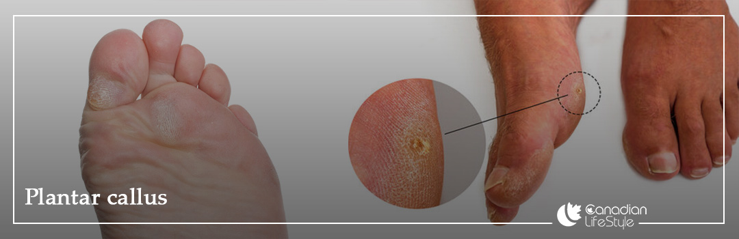 Plantar callus
