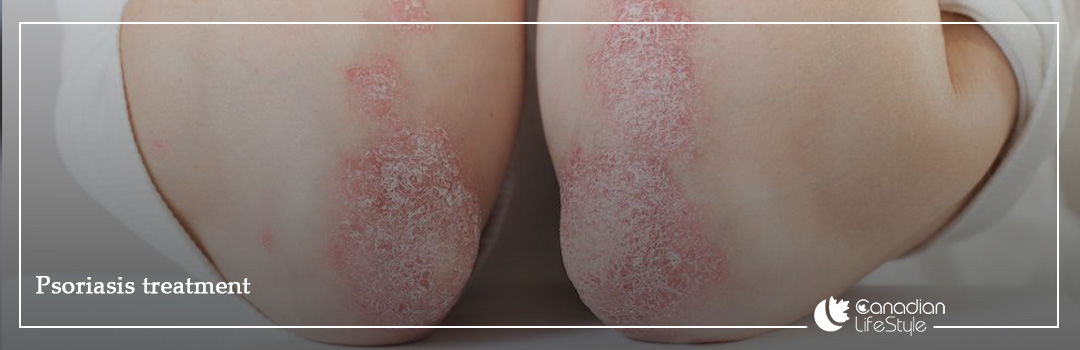 best way to treat psoriasis