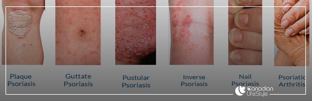psoriasis photos