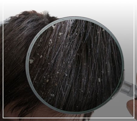  Dandruff - Diagnosis and treatment of dandruff