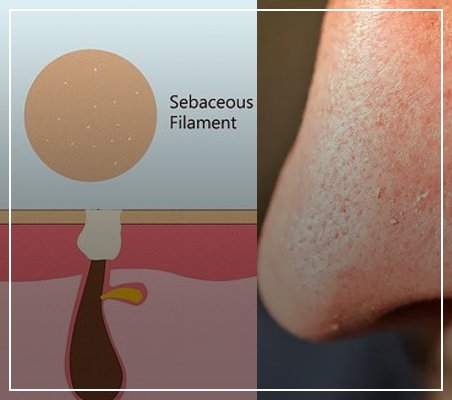 What is a fatty filament and how is it treated?