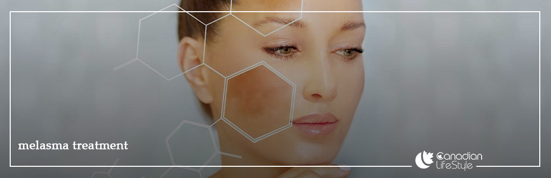 Melasma