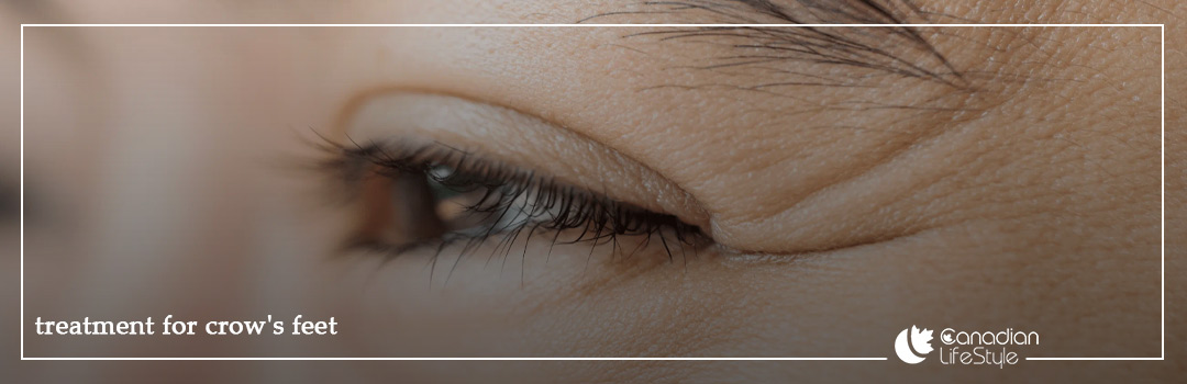 treatment for crow's feet